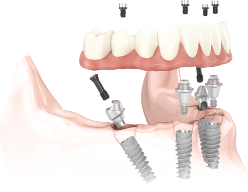 Clínica Dental Reverte Clínica Dental Reverte