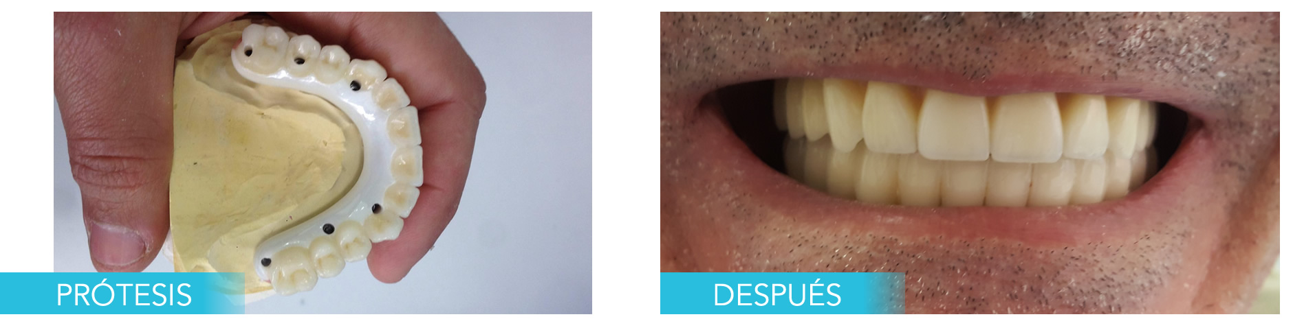 Implantes Dental Reverte