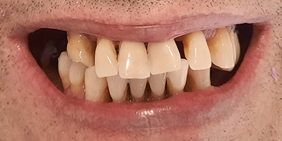 Implantes Dentales Antes