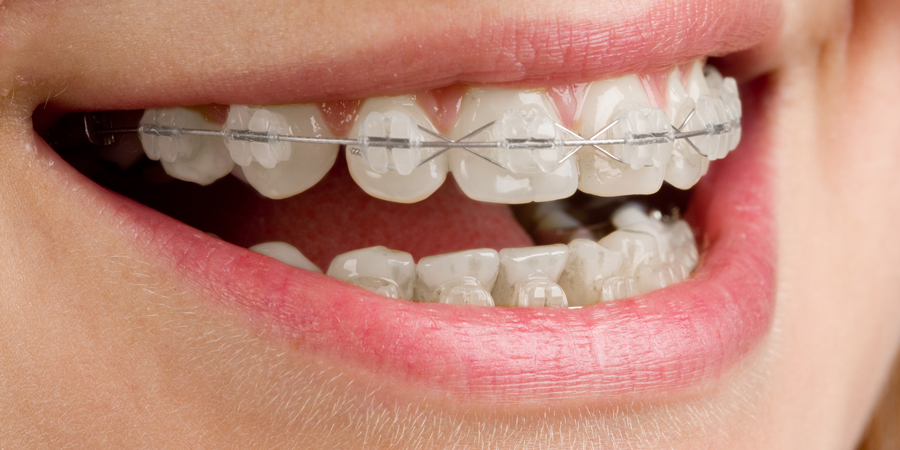 Tipos de ortodoncia que pueden dejarte tus dientes rectos y sus precios
