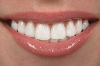 Carillas Dentales Carillas Dentales