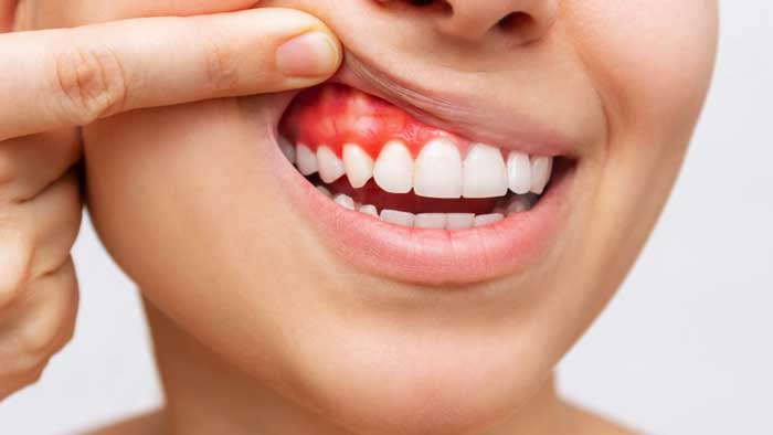 tratamiento periodoncia tratamiento periodoncia