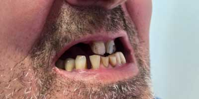 Implantes Dentales Despues