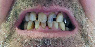 Implantes Dentales Despues