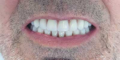 Implantes Dentales Despues