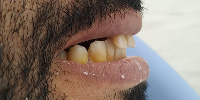 Implantes Dentales Después