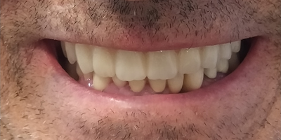 Implantes Dentales Después