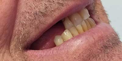 implantes dentales despues