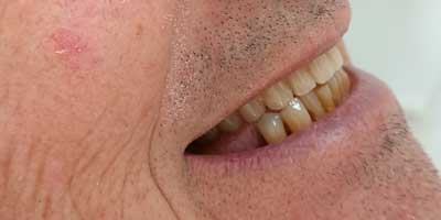 implantes dentales despues