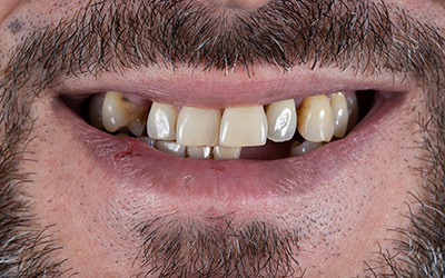 Carillas Dentales FirstFit