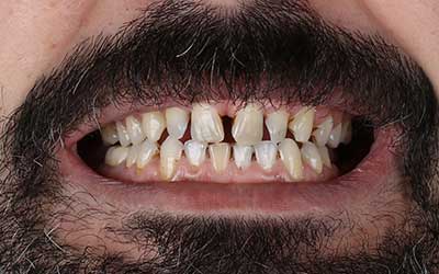 Carillas Dentales FirstFit