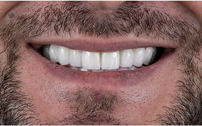 Carillas Dentales FirstFit