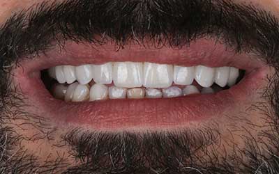 Carillas Dentales FirstFit